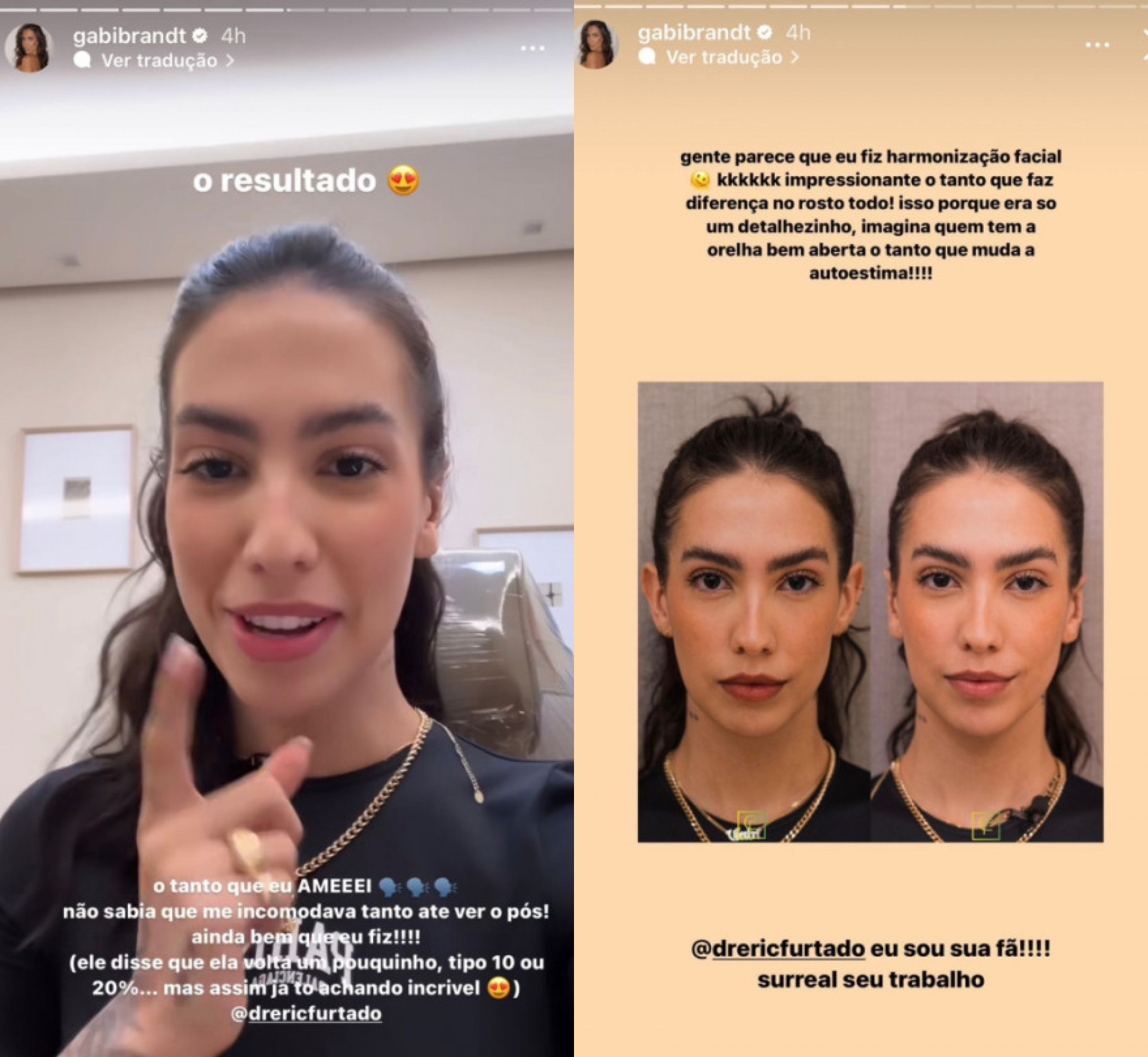 Gabi Brandt realiza procedimento estético para 'fechar' orelhas - Reprodução