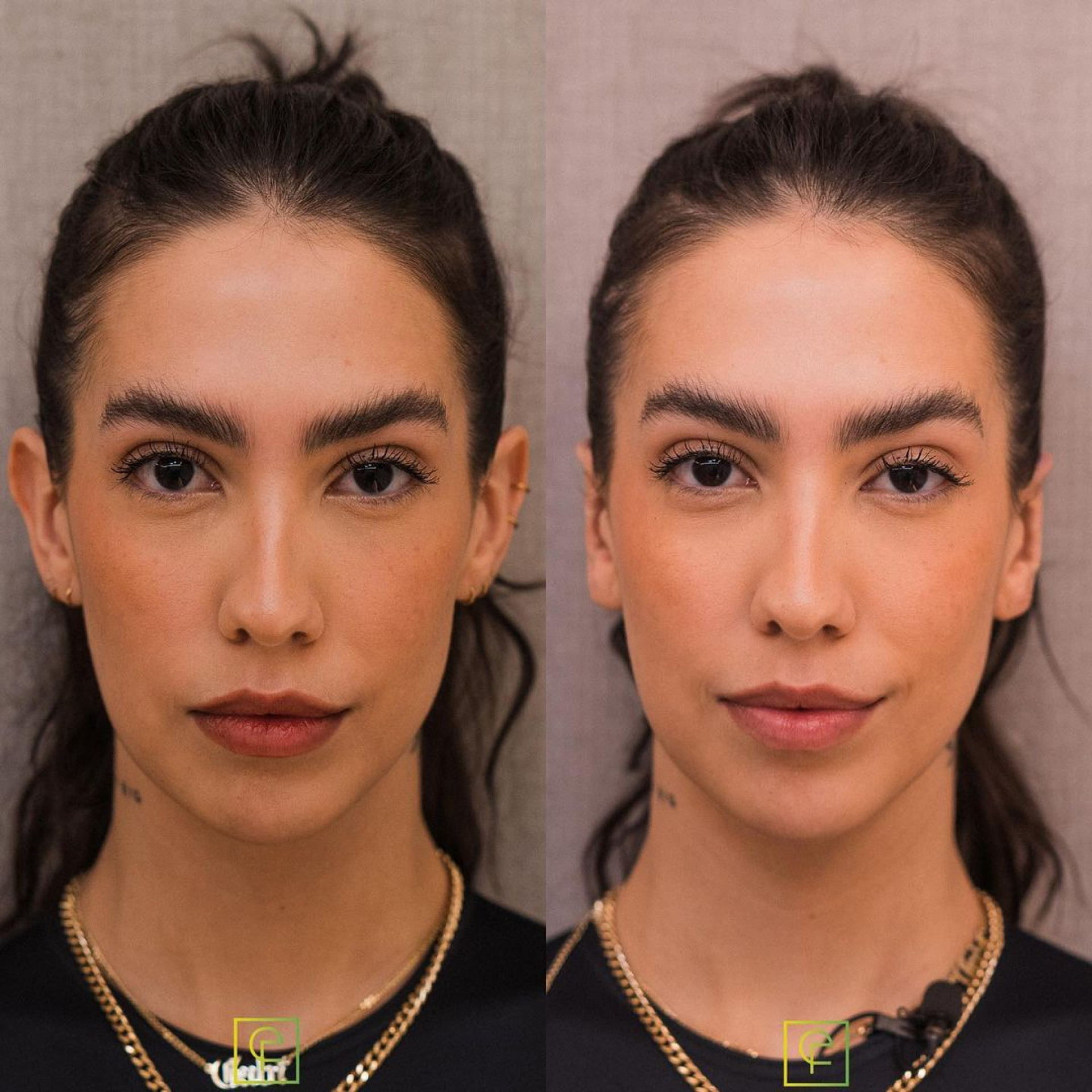 Antes e depois de procedimento estético da Gabi Brandt para 'fechar' orelhas - Reprodução
