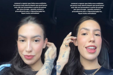 Gabi Brandt realiza procedimento estético nas orelhas; Veja antes e depois