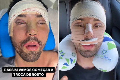 Rico Melquiades passa por cirurgia no rosto e declara: 'Fiz para seguir o padrão'