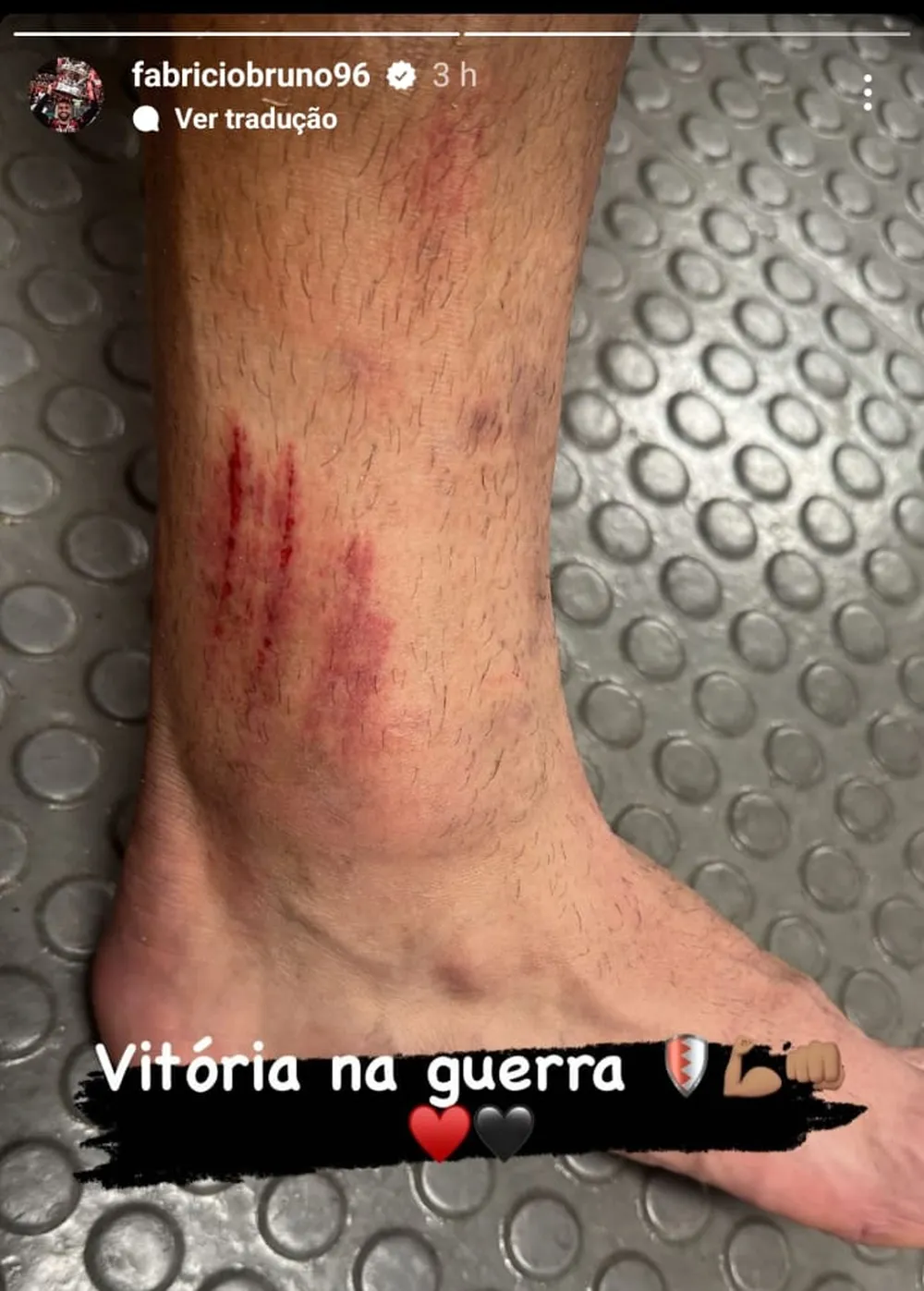 Fabrício Bruno mostra tornozelo machucado após Flamengo x Vasco