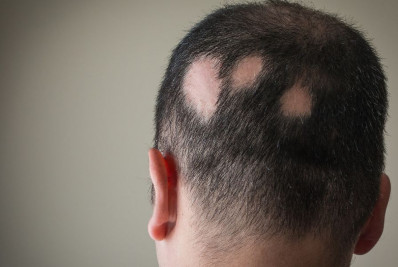Baricitinibe: Anvisa aprova novo remédio para tratamento de alopecia areata