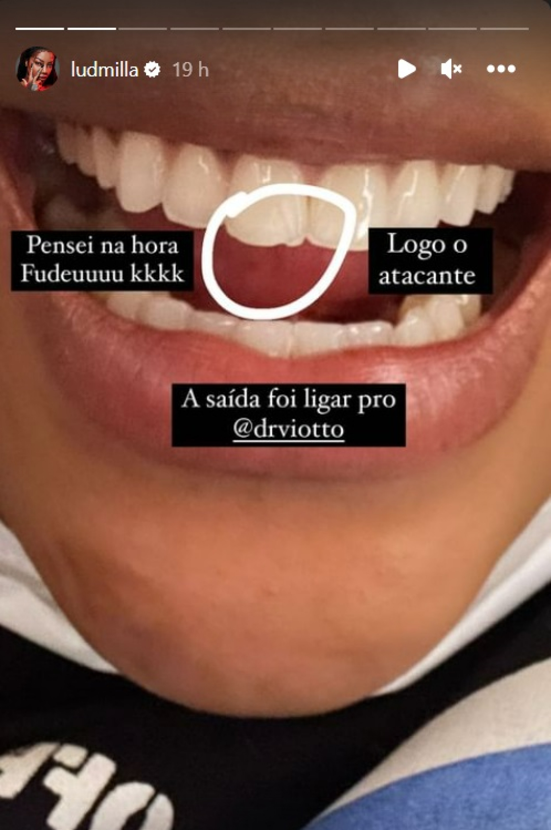 Ludmilla quebra dente durante show - Reprodução do Instagram