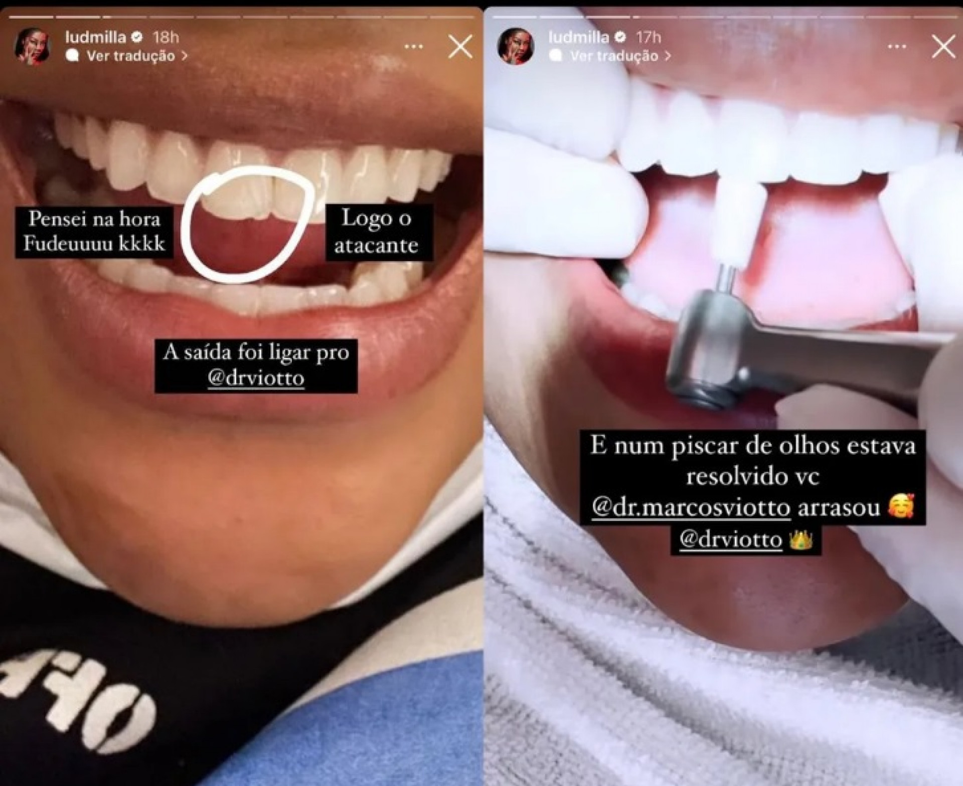 Ludmilla quebra dente durante show - Reprodução do Instagram