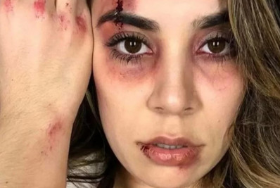 Fotos: Hematomas no corpo de Naiara Azevedo são expostos após denúncia de agressão contra ex