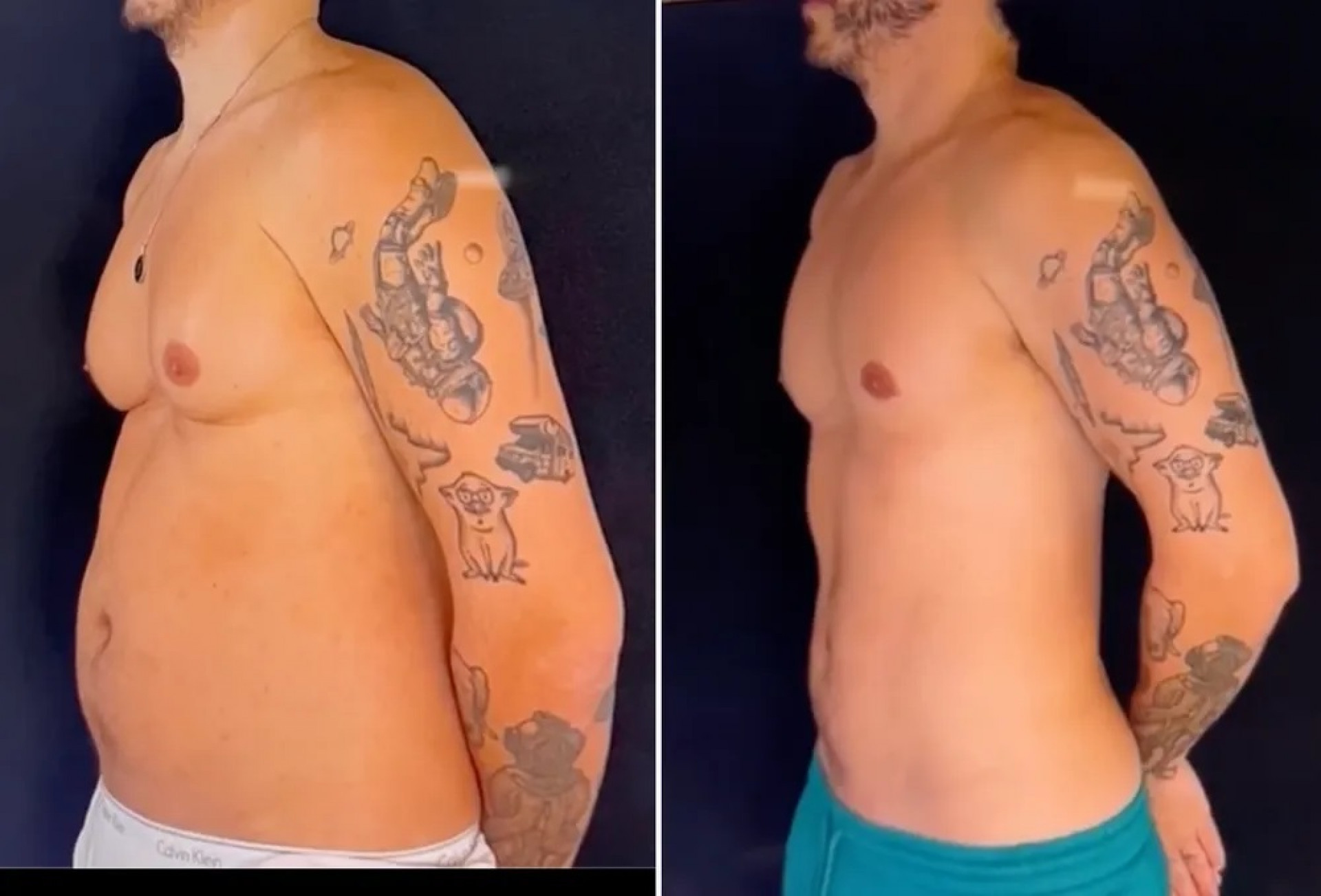 Eliezer mostra antes e depois após plástica - Reprodução / Instagram