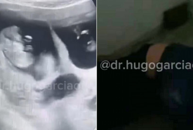 Pai de dois, homem desmaia durante ultrassom ao descobrir que mulher terá trigêmeos