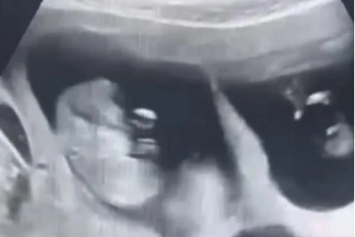 Pai de dois, homem desmaia durante ultrassom ao descobrir que mulher terá trigêmeos