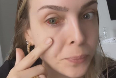 Tata Estaniecki reclama sobre aparência durante recuperação de derrame ocular: 'Desânimo'