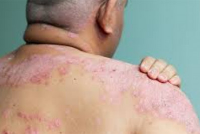 Diagnósticos de hanseníase cresceram 5% entre janeiro e novembro de 2023