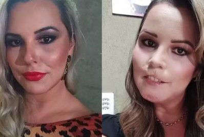 Influencer tem o lábio superior retirado após realizar harmonização facial com PMMA
