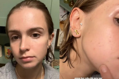 Isabella Scherer desabafa sobre lidar com acne e conta que recorrerá a remédio pela quinta vez