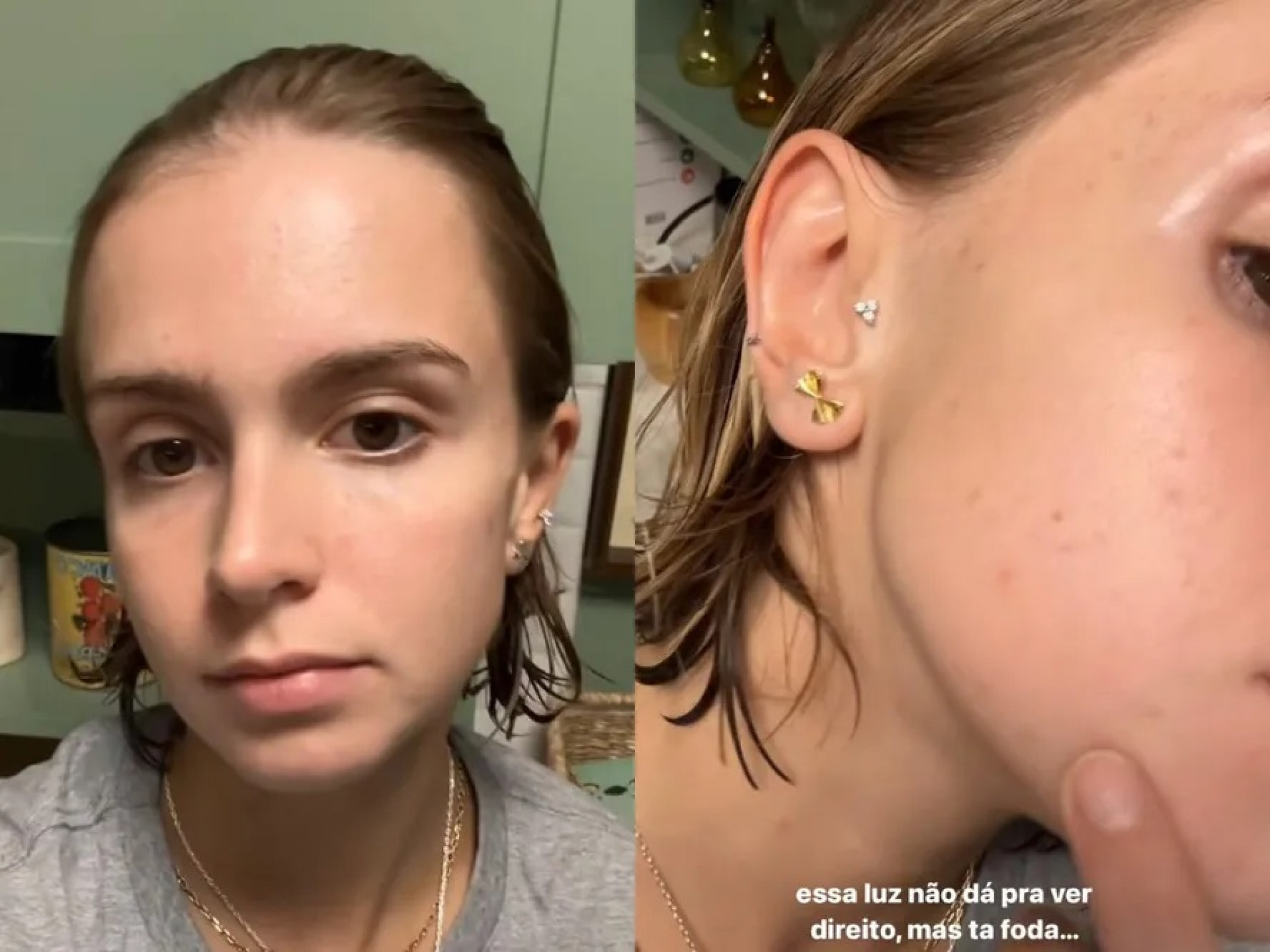Isabella Scherer lamenta surgimento de acnes e conta que passará por tratamento pela quinta vez - Reprodução / Instagram