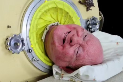 Homem que vivia em 'pulmão de ferro' morre aos 78 anos