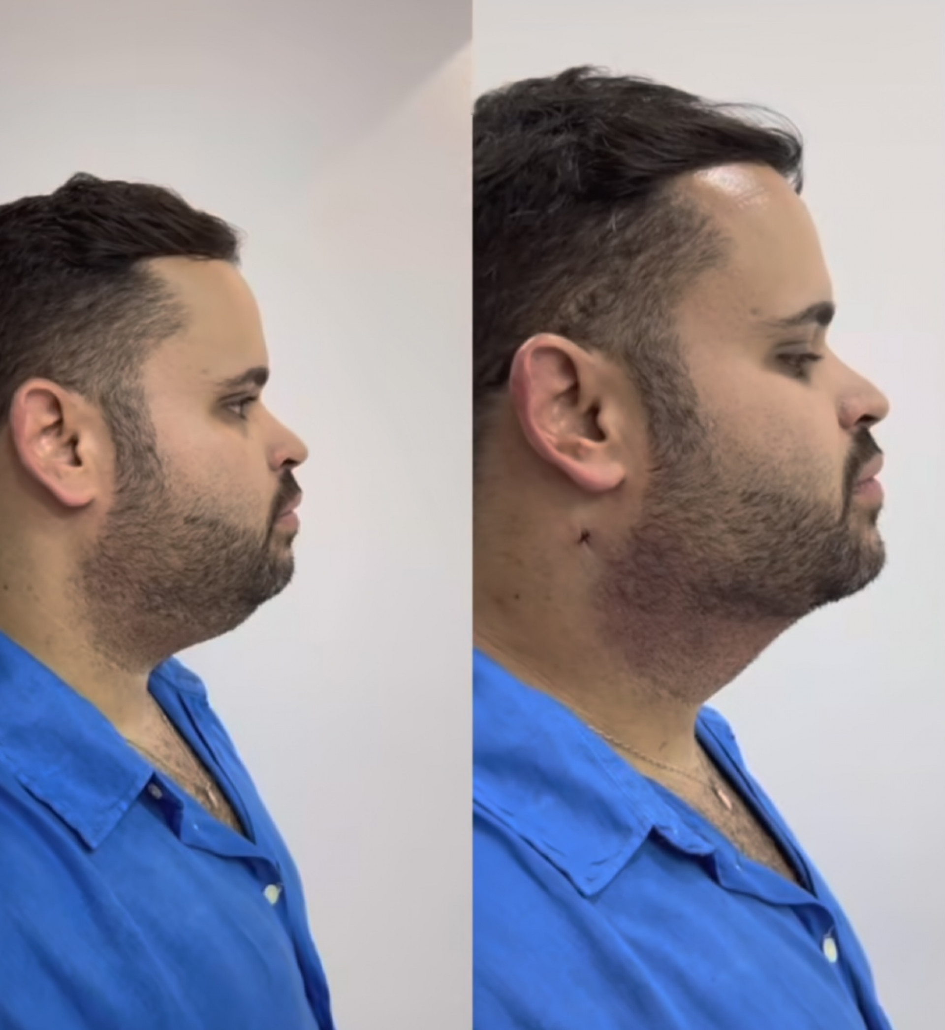 Michel, do 'BBB 24', realiza harmonização facial - Reprodução