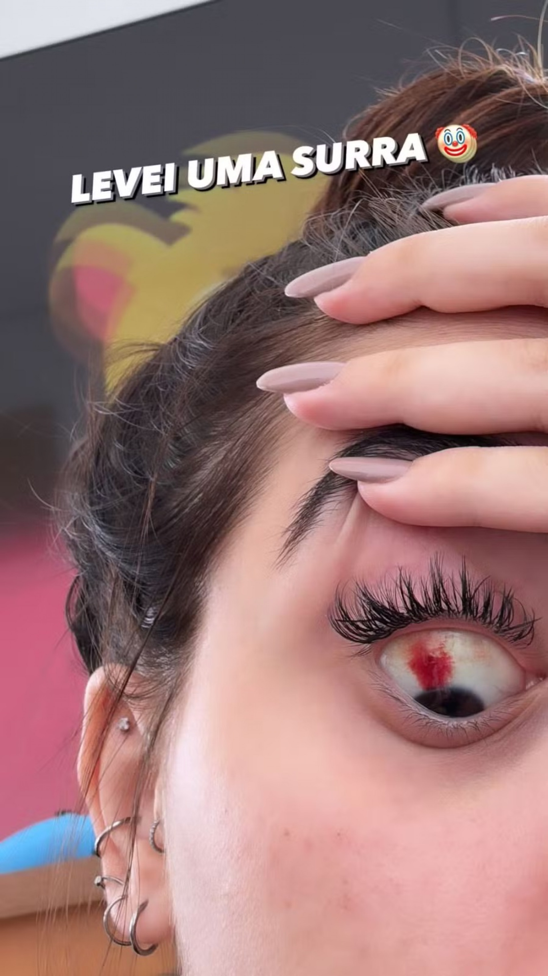 MC Mirella descobre derrame ocular  - Reprodu&ccedil;&atilde;o/Instagram