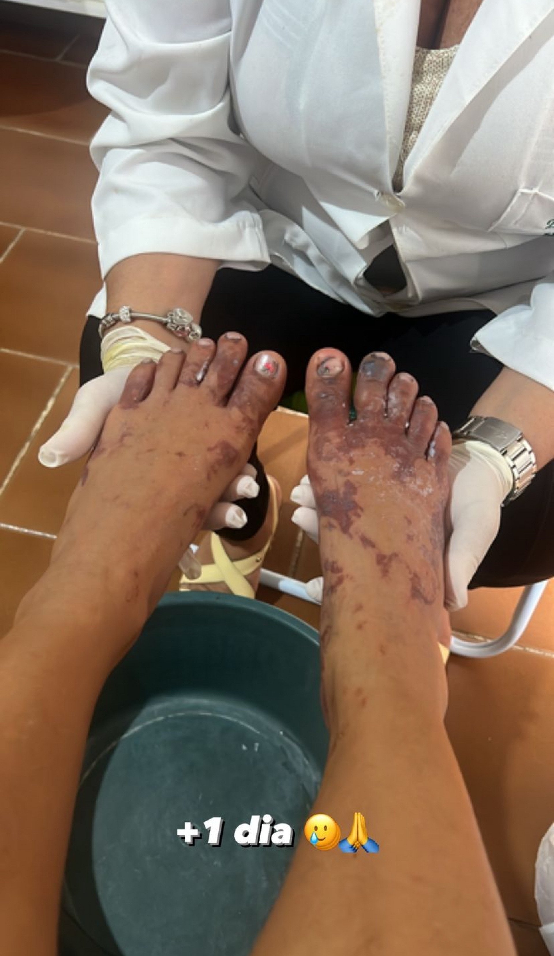 MC Thammy exibe estado do pé após queimadura com gelo em reality - Reprodução/Instagram