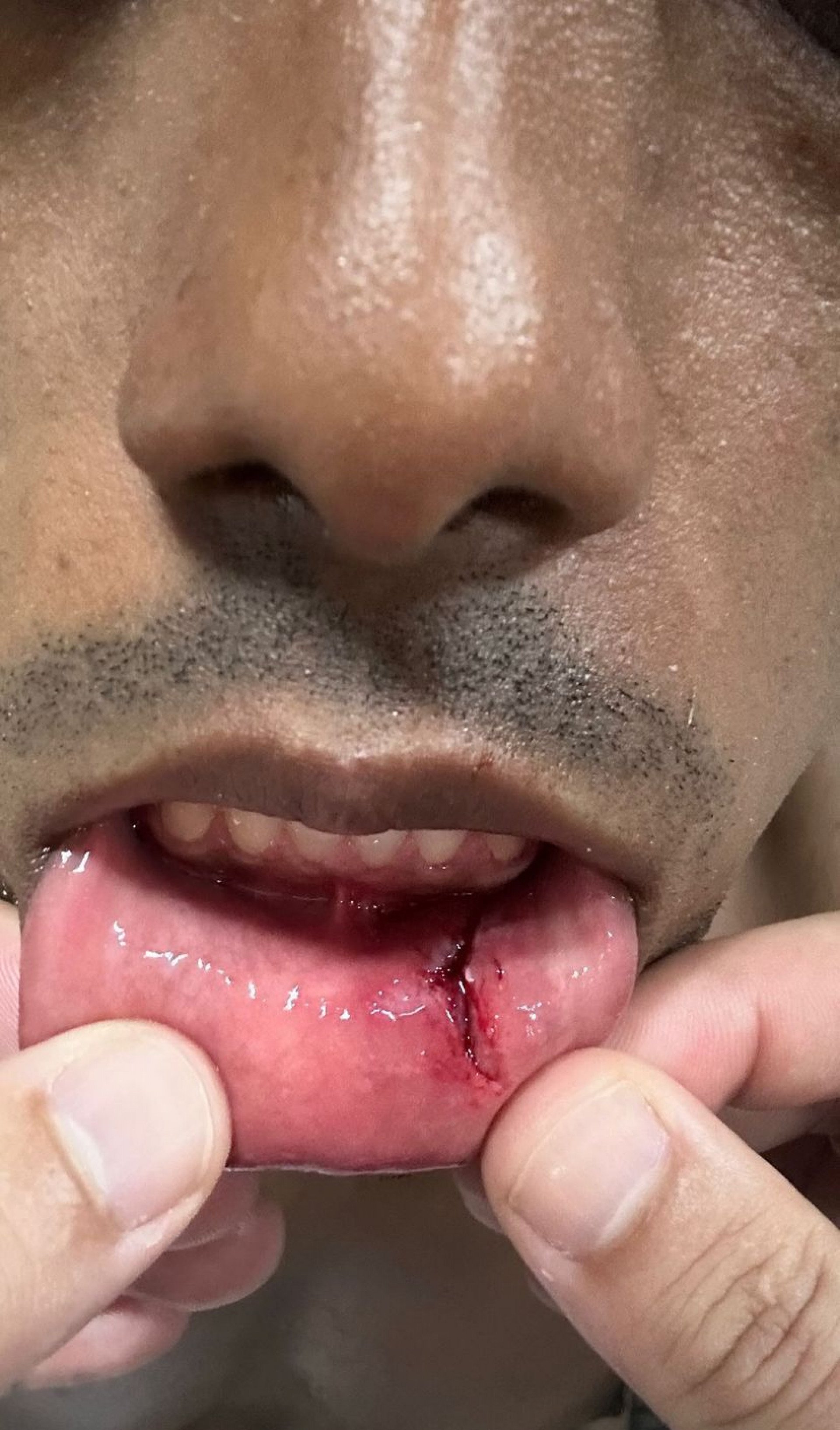 Corte na boca de Bruno Henrique - Reprodução/Instagram @b.henrique