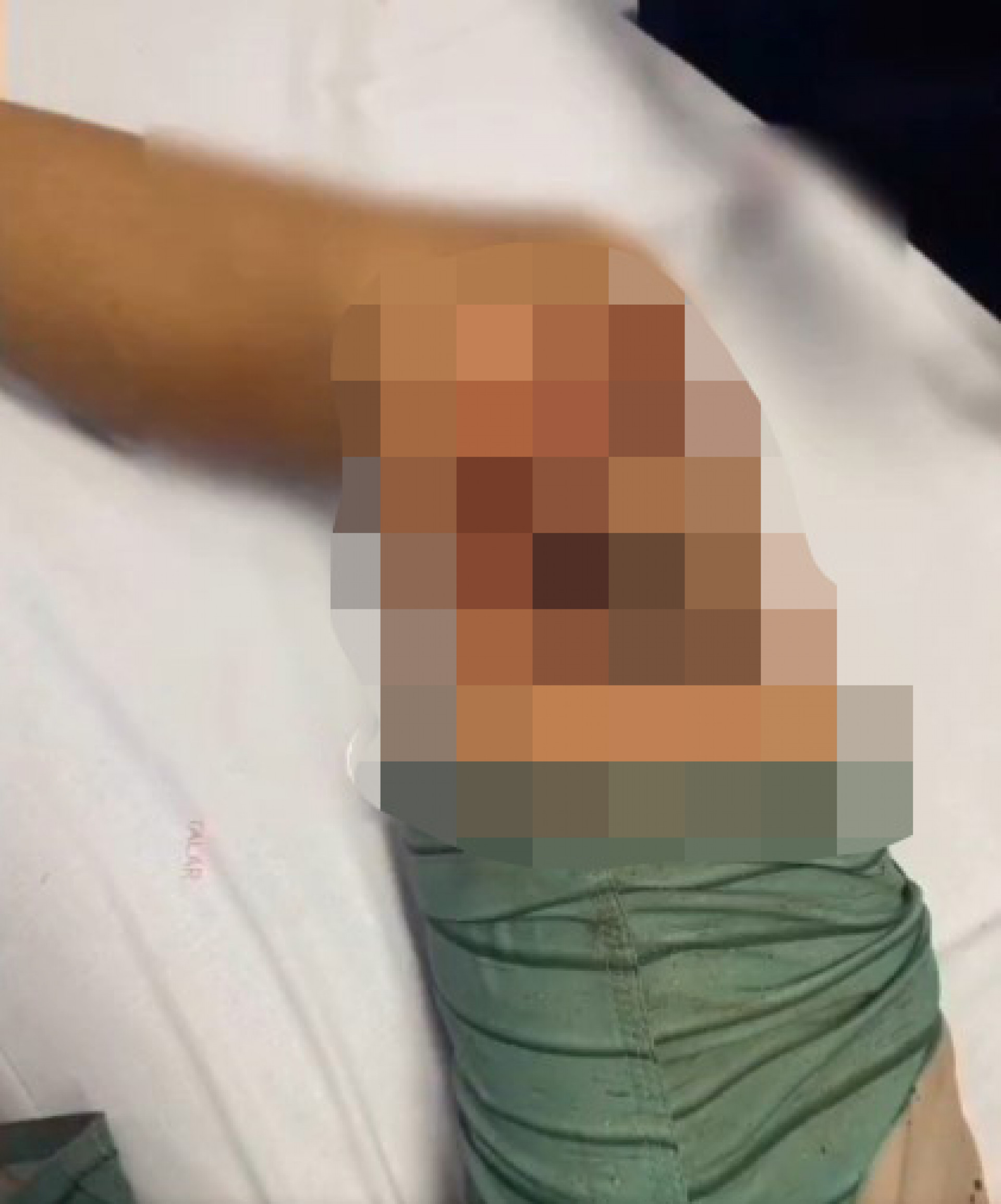 Adolescente passou por cirurgia e deve permanecer internado por conta da mordida - Reprodução