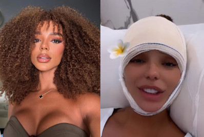 Brunna Gonçalves faz cirurgia de frontoplastia: 'Realizei meu grande sonho'