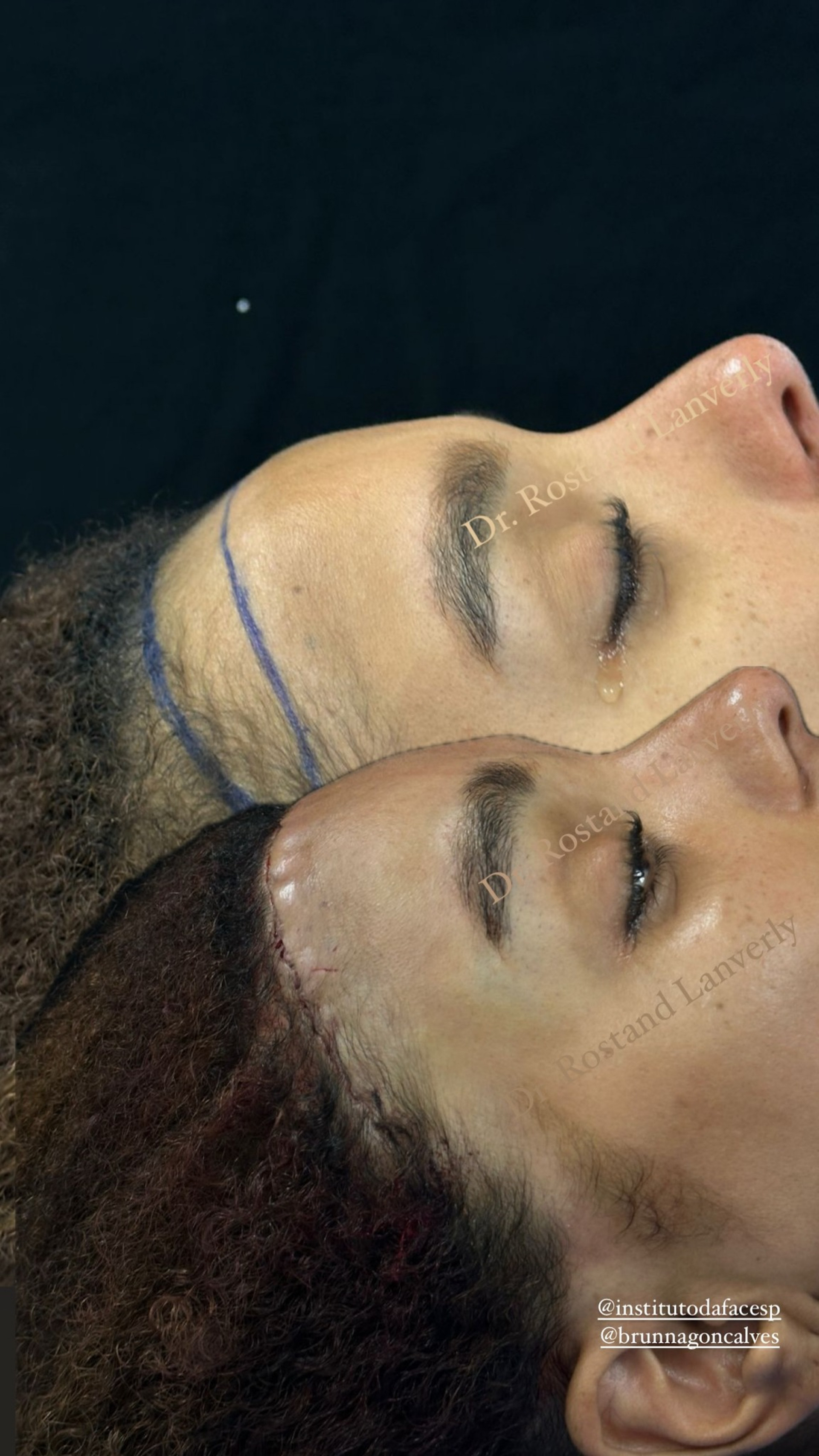 Antes e depois da cirurgia de redução de testa de Brunna Gonçalves  - Reprodução / Instagram 