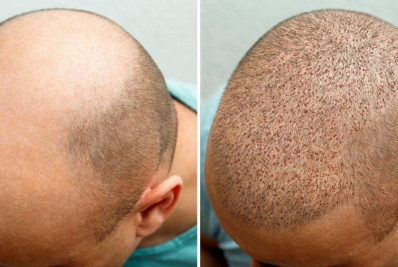 Implante capilar: Tudo o que você precisa saber sobre a técnica queridinha dos famosos