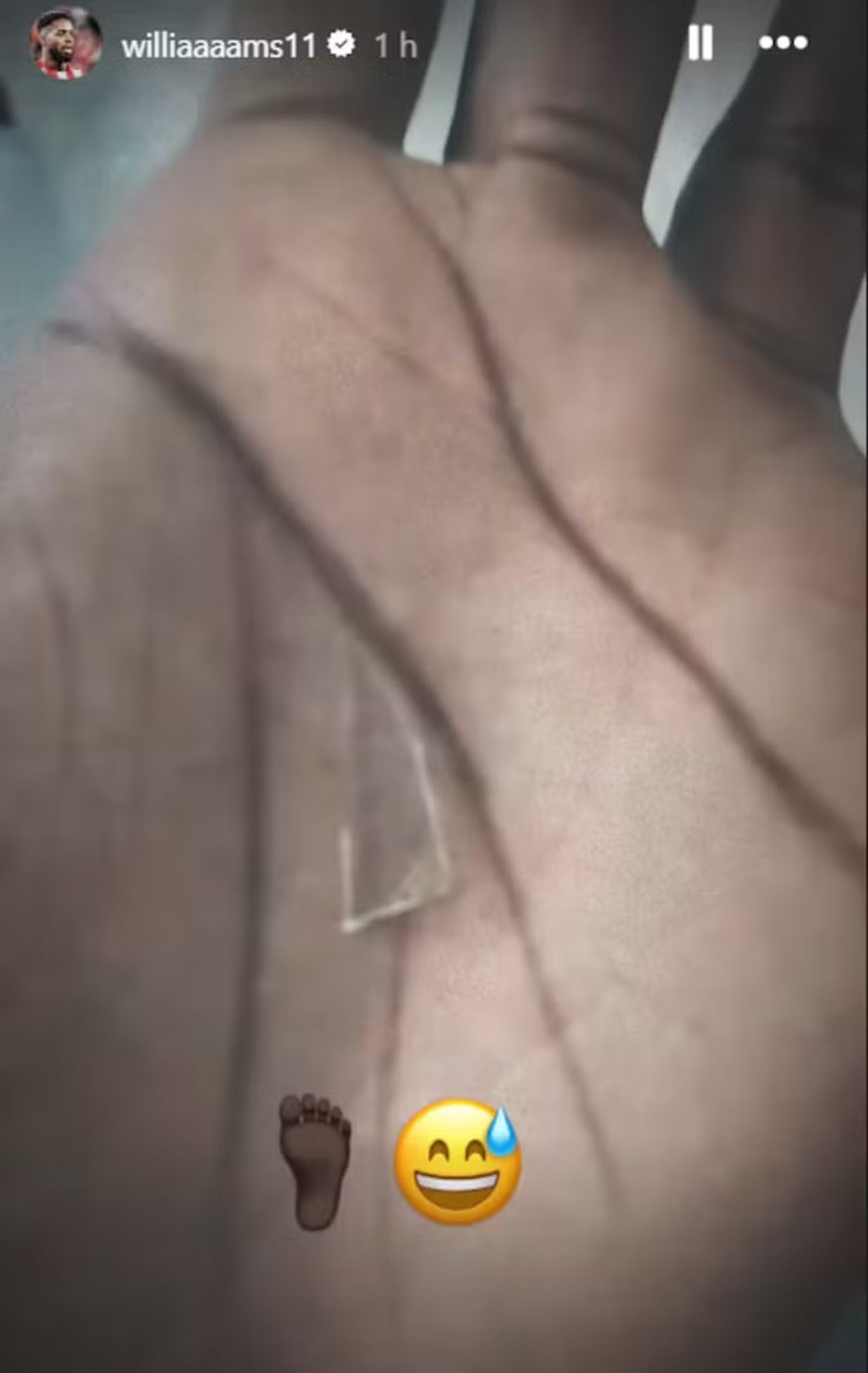 Nas redes sociais, Iñaki Williams publicou foto do pedaço de vidro que estava em seu pé - Reprodução / Instagram