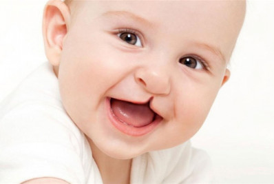 Hospitais públicos e privados vão ter que realizar teste de fissura labiopalatal em recém-nascidos