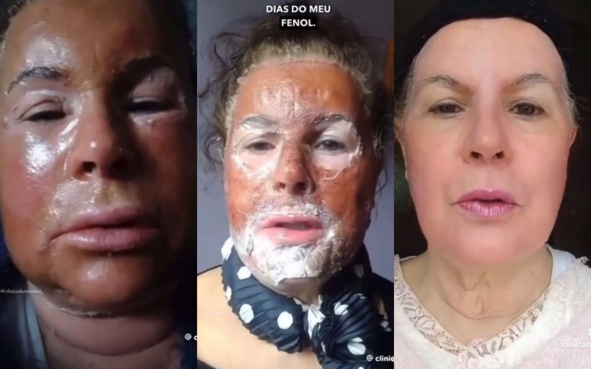 Internautas compartilham resultados do peeling de fenos nas redes sociais