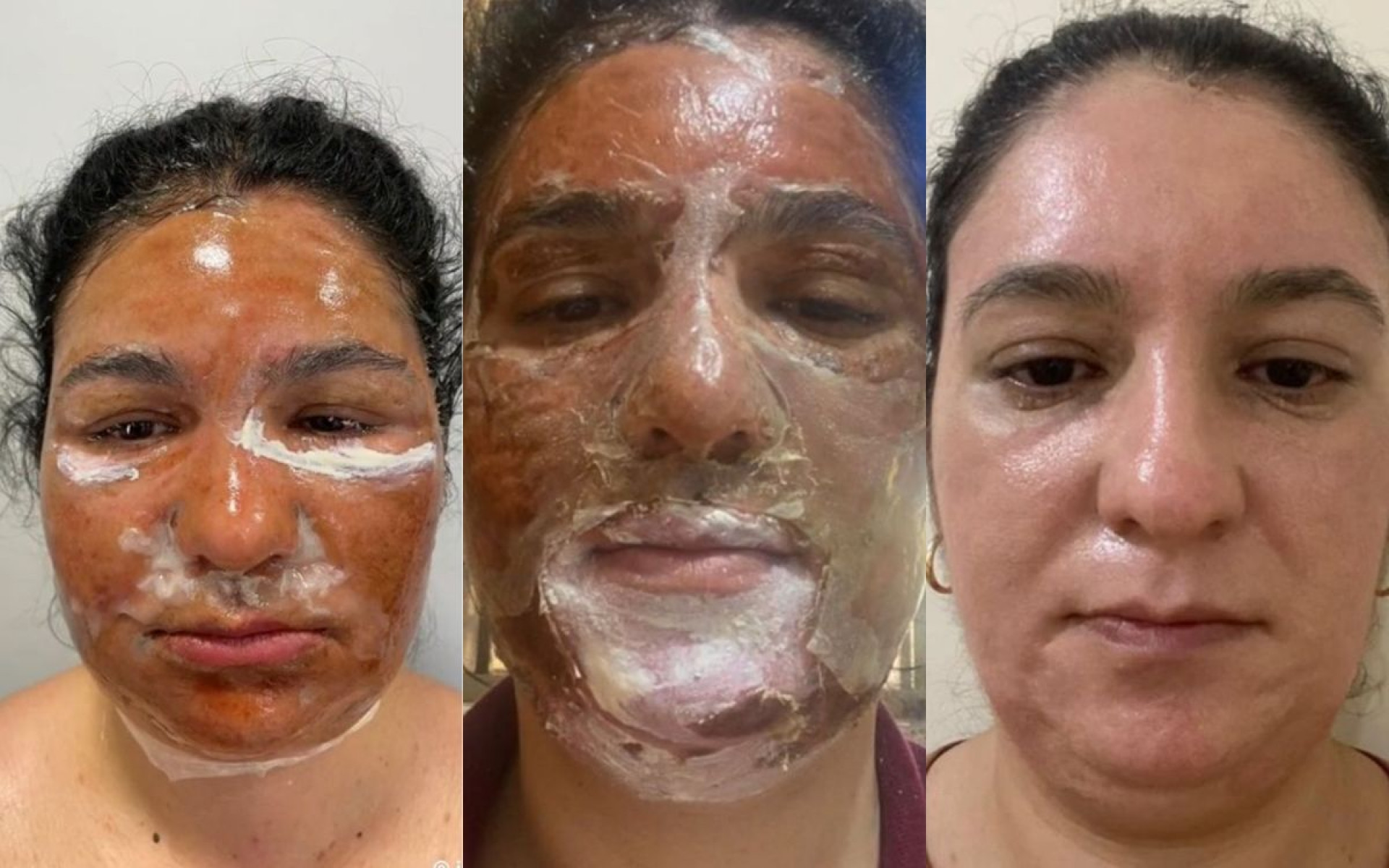 Internautas compartilham resultados do peeling de fenos nas redes sociais - Reprodução / TikTok