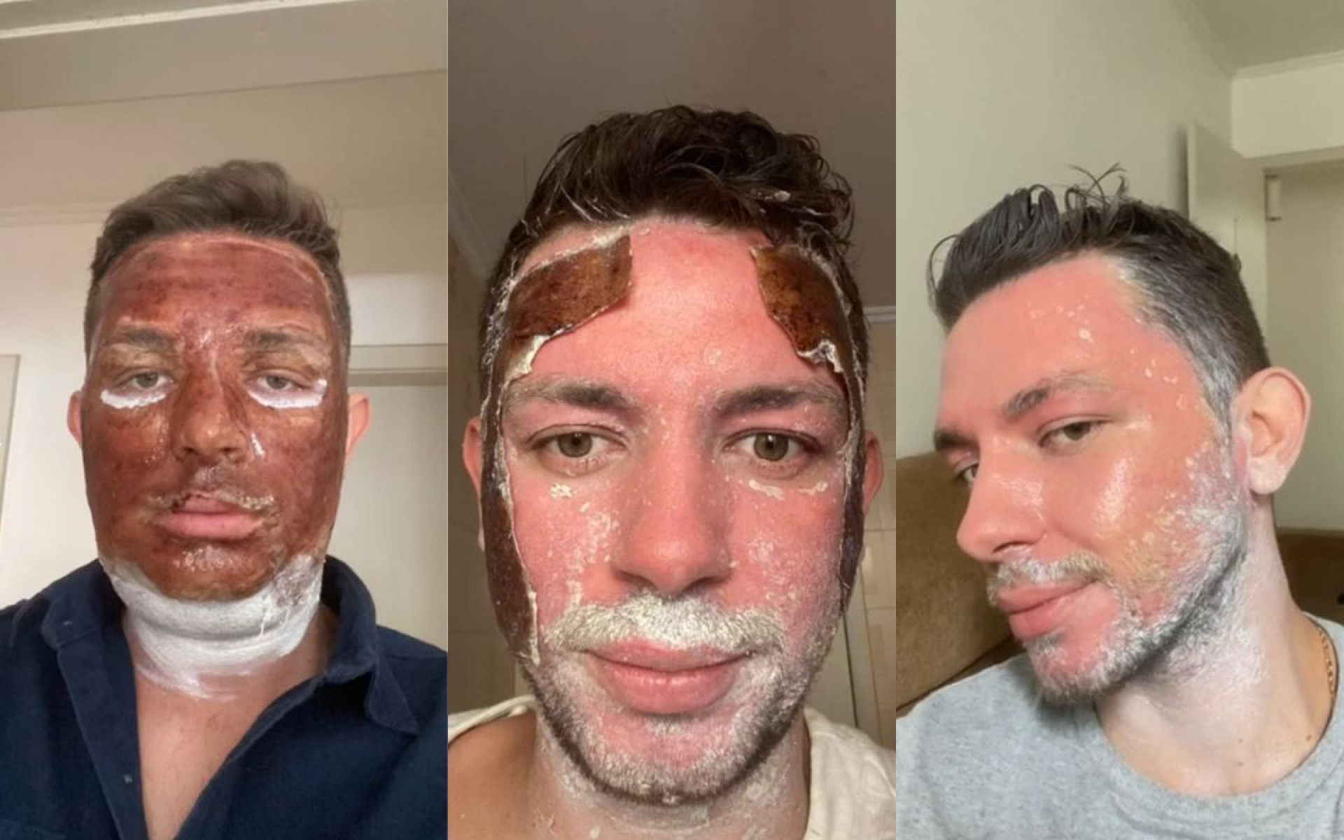 Internautas compartilham resultados do peeling de fenos nas redes sociais - Reprodução / TikTok