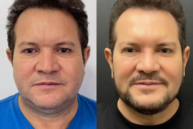Ximbinha faz procedimentos no rosto para rejuvenescer; veja antes e depois