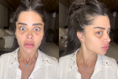 Aline Campos faz transplante de sobrancelha e mostra hematomas