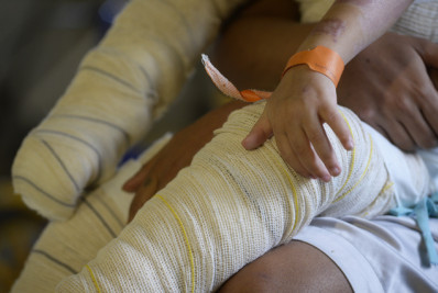 SUS registra 14 mil casos de internação por queimadura de crianças e adolescentes