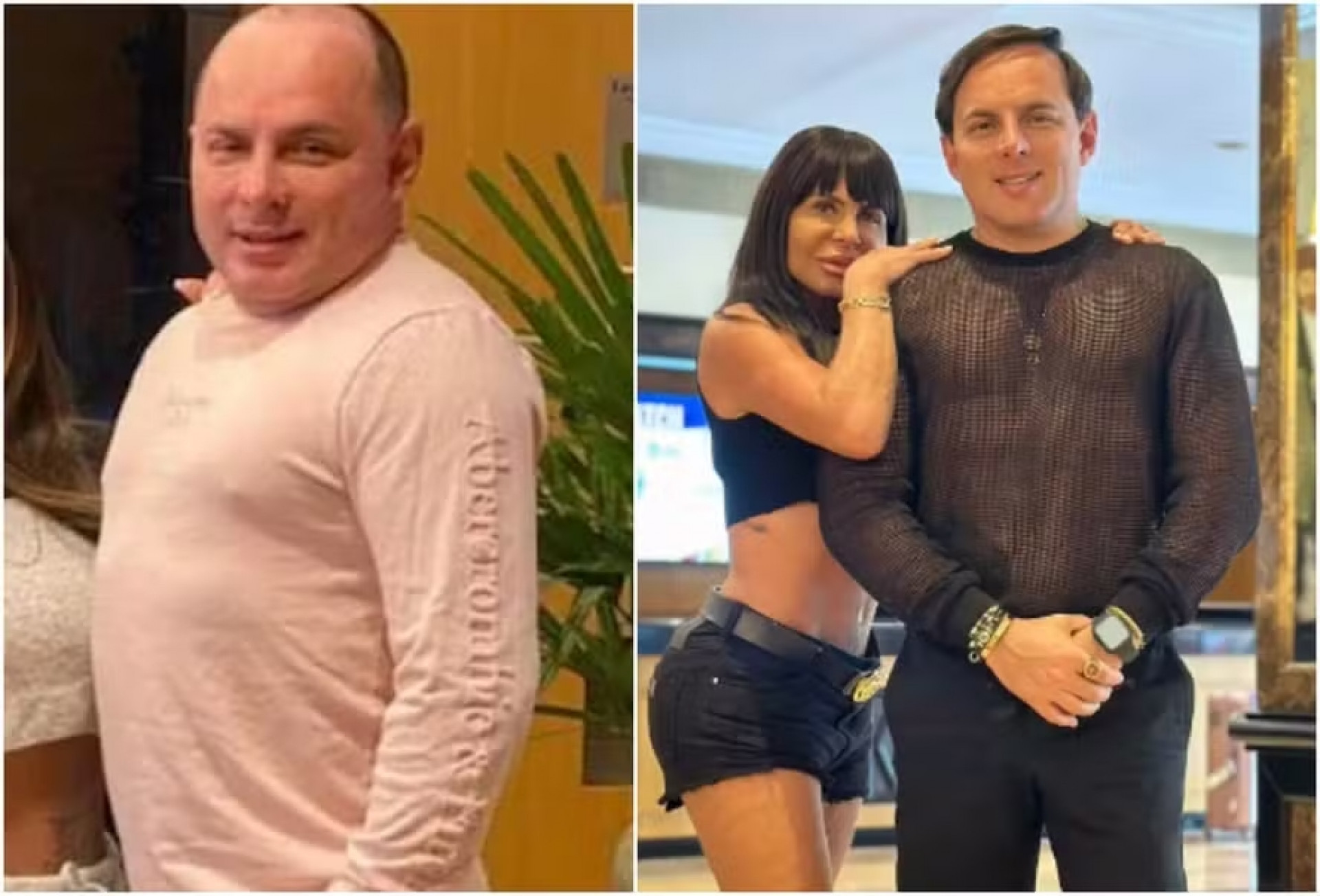 Marido de Gretchen compartilha antes e depois de procedimentos estéticos - Reprodução / Instagram