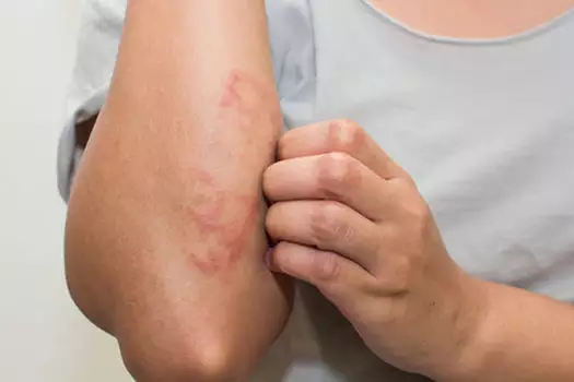 Escola municipal de Santos fecha por aumento de casos de sarna humana