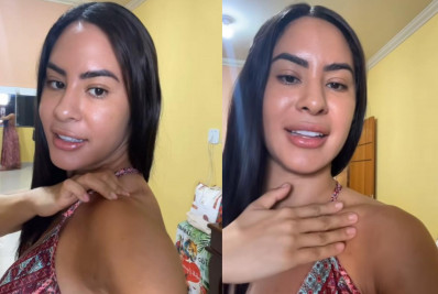 Isabelle Nogueira mostra hematomas após Festival de Parintins: 'Cheia de marcas'