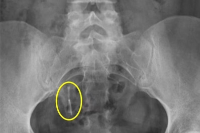 Mulher encontra DIU, 'perdido' há 12 anos, no reto após acidente