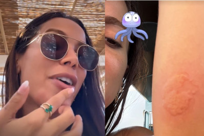 Anitta é queimada por água-viva em Ibiza: 'Dor do fim da vida'