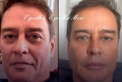 Marcello Antony faz harmonização facial e é comparado ao boneco Ken