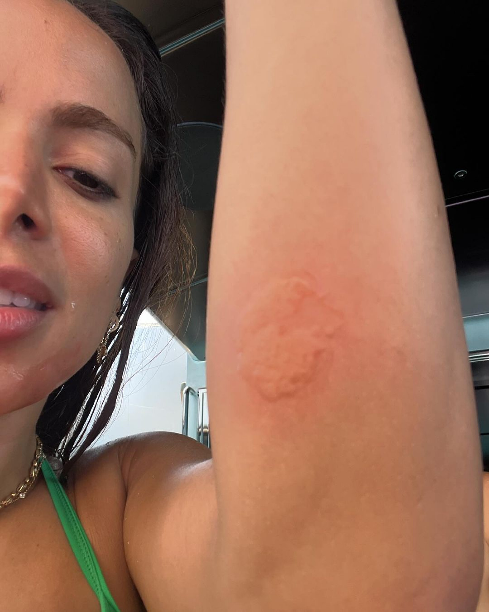 Anitta compartilha fotos de viagem para Ibiza após ser queimada por água-viva - Reprodução