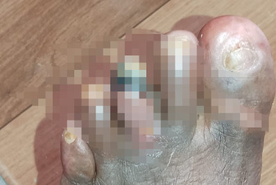 Pela segunda vez, moradora corre risco de perder dedo por diabetes