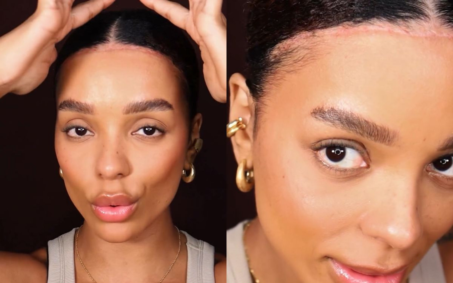 Brunna Gon&ccedil;alves mostra resultado de cirurgia de redu&ccedil;&atilde;o de testa - Reprodu&ccedil;&atilde;o / Instagram