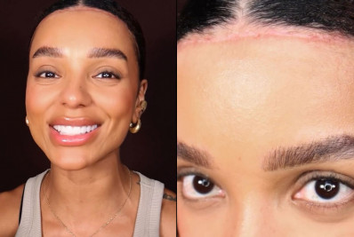 Brunna Gonçalves mostra resultado de frontoplastia após dois meses