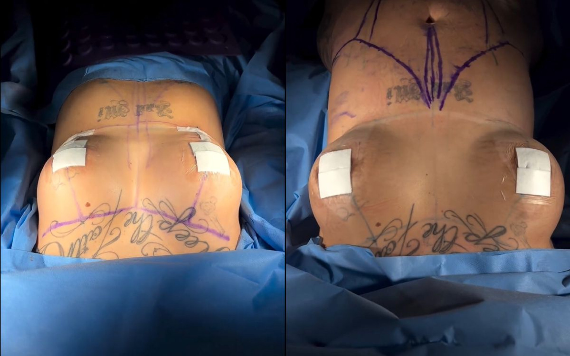 Antes e depois das cirurgias plásticas de MC Mirella - Reprodução / Instagram