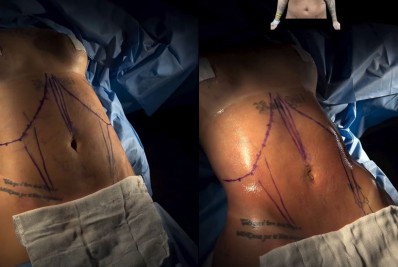 MC Mirella compartilha resultado de cirurgias plásticas e celebra: 'Espetacular'; veja antes e depois