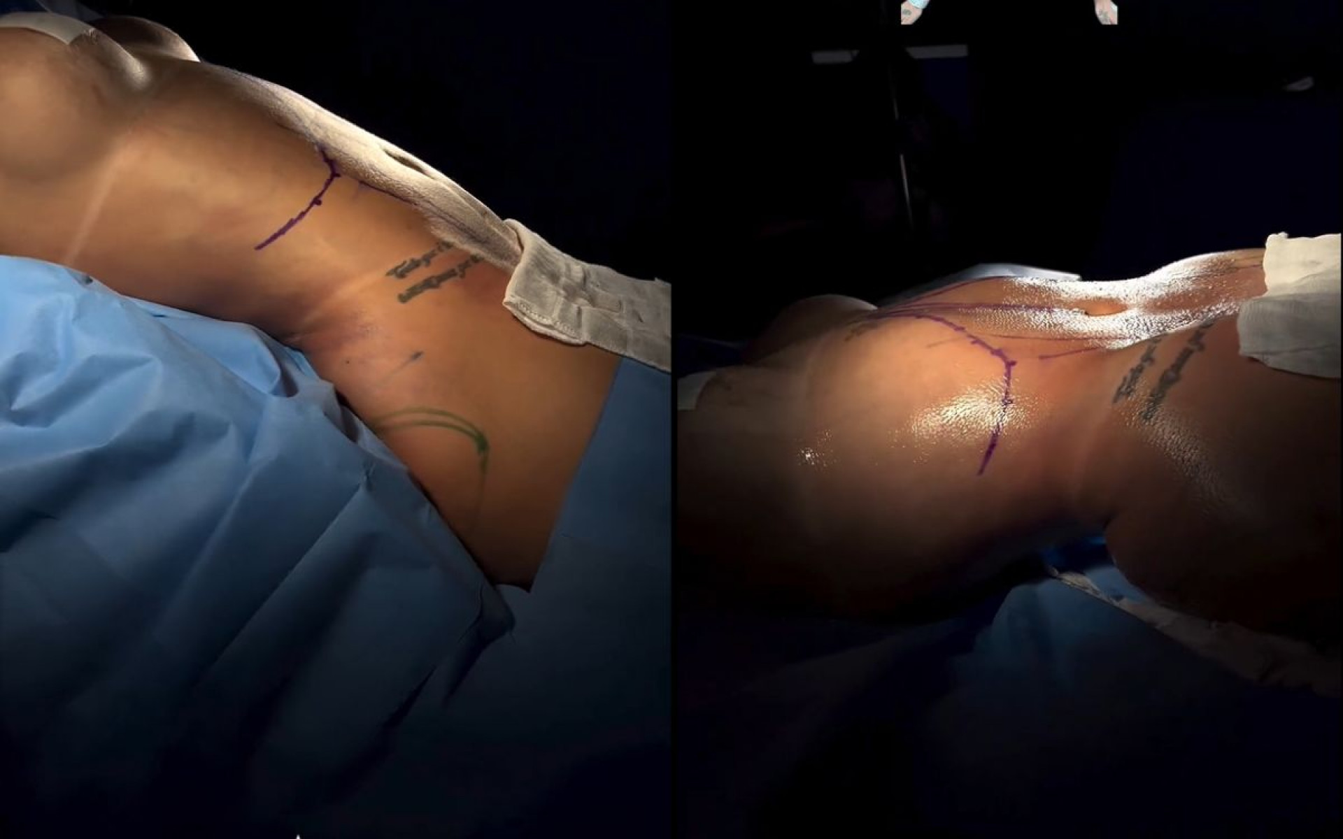 Antes e depois das cirurgias plásticas de MC Mirella - Reprodução / Instagram