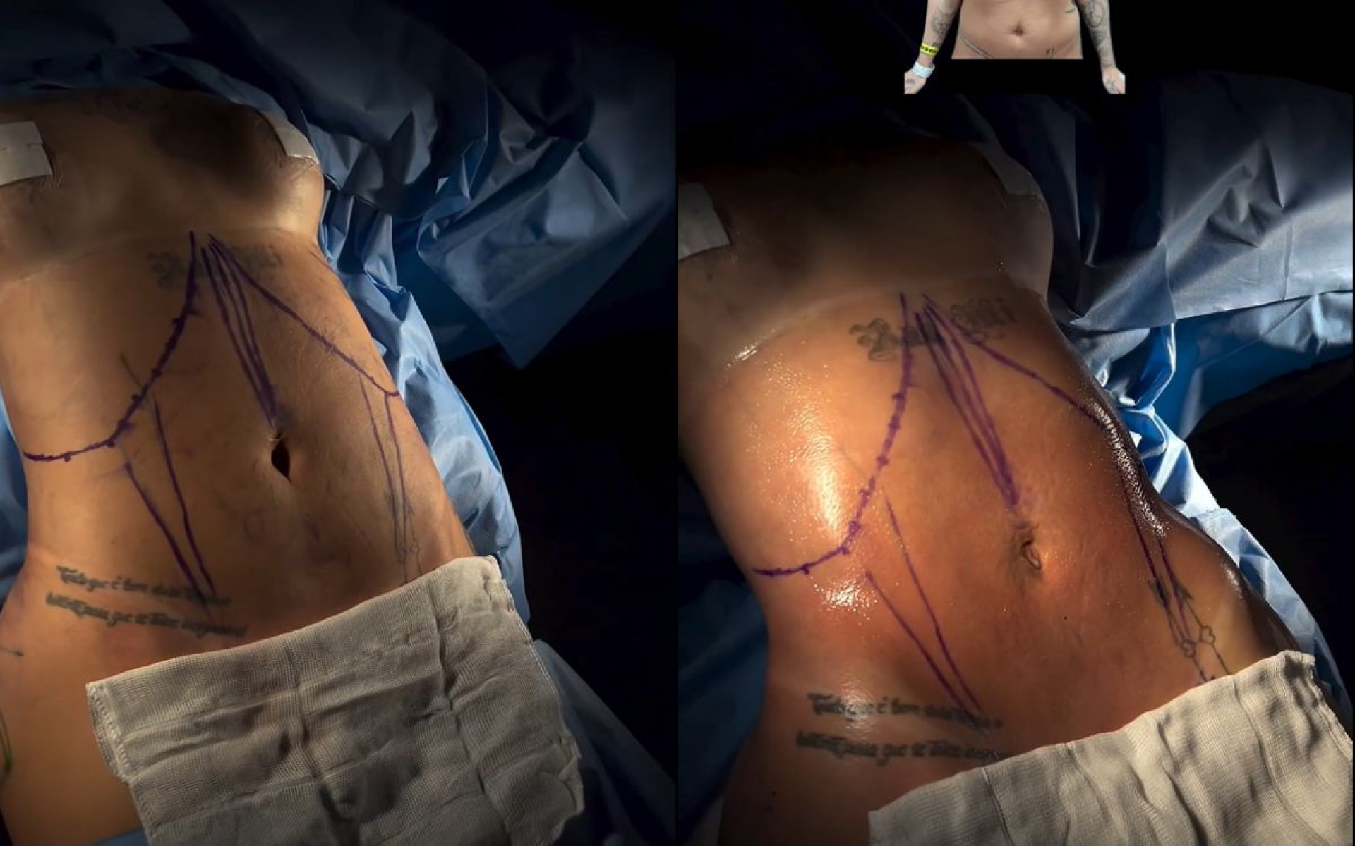 Antes e depois das cirurgias plásticas de MC Mirella - Reprodução / Instagram