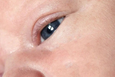 Ministério atualiza ações para prevenção de conjuntivite neonatal