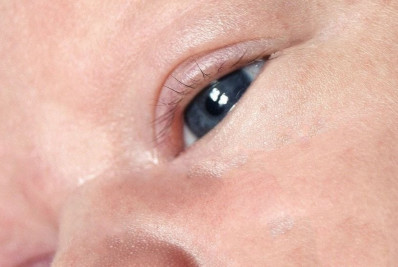 Ministério da Saúde atualiza ações para prevenção de conjuntivite em recém-nascidos